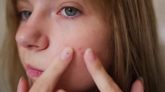 Close-up of teenage girl examining acne-prone skin and squeezing pimple on cheek while look at reflection. Concept of acne treatment, teenage skincare, facial imperfections, hormonal skin changes