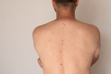 Naklejka premium Male Back with Multiple Moles for Skin Cancer and Dermatology Examination