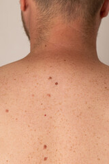 Naklejka premium Male Back with Multiple Moles for Skin Cancer and Dermatology Examination