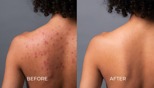 The back of a person is shown with widespread acne and redness before and clear, unblemished skin after a successful dermatological treatment.