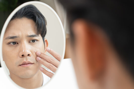 Asian men worry about acne on their faces when looking in the mirror