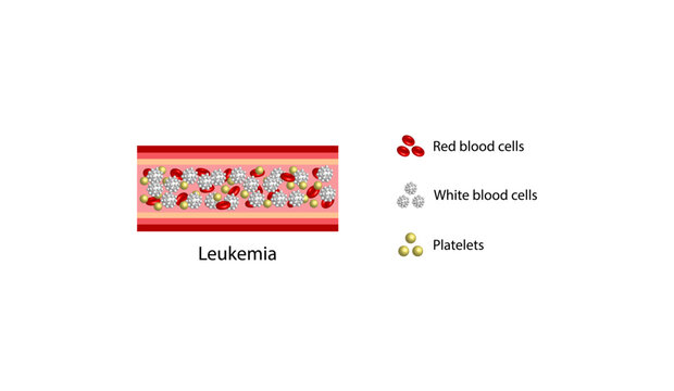 Leukemia, blood cancer. Red blood cells, platelets and lymphocytes. Vector illustration.