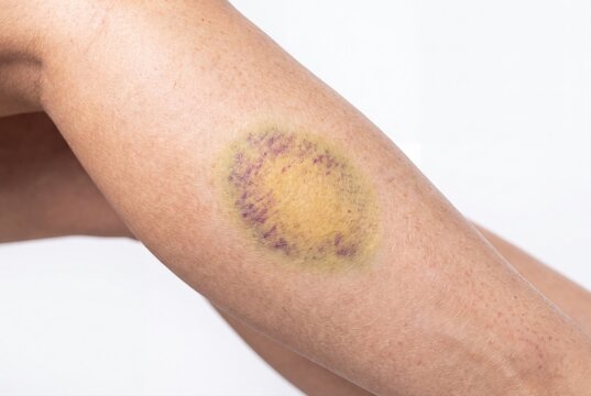 Large bruise on woman leg skin contusion trauma hematoma injury health