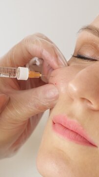 Close up shot of a professional dermatologist injecting a dermal filler into a woman's nasolabial fold, showcasing a modern cosmetic surgery procedure for skin rejuvenation