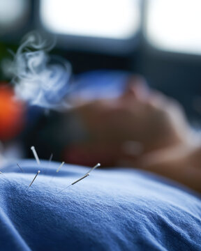 Acupuncture needle on cloth in clinic with steam and blurred background