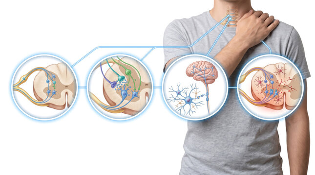 Cervical Radiculopathy Pinched Nerve Neck Pain Cervical Spine, Medical illustration showing compressed spinal nerve causing shoulder pain and neurological symptoms