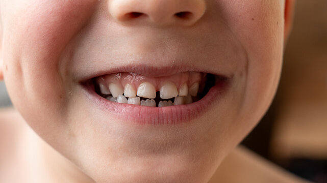 Child's smile. Child's teeth. Baby white teeth of a white-skinned person. Two permanent lower teeth. Even white teeth of a 5-year-old child.