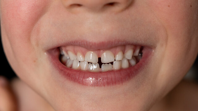 Child's smile. Child's teeth. Baby white teeth of a white-skinned person. Two permanent lower teeth. Even white teeth of a 5-year-old child.