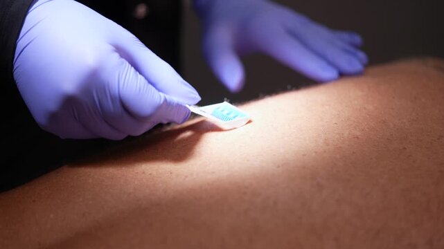 Preparing Patient's Back for Laser Hair Removal
