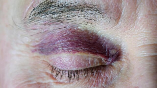 Eye senior man showing signs bruising, redness and hemorrhage. Medical condition, injury, hematoma, and healing process, blood vessel, violence and accident