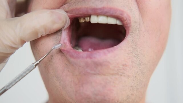 dentist prosthesis examining man Patient mouth, open mouth Mixed natural and prosthetic teeth and gums, dental checkup restoration, oral inspection, stomatology healthcare, medical modern dentistry