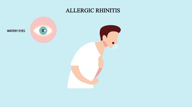 Medical vector animation illustrating common symptoms of allergic rhinitis, including sneezing, watery eyes, runny or blocked nose, and itchy nose, throat, and mouth. Suitable for healthcare education