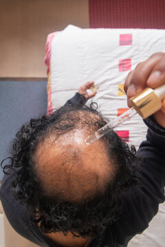 Close-up of hair loss treatment application on a man's crown using a glass dropper