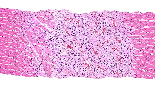 Granulation Tissue After Myocardial Infarction Histopathology H&E Healing Heart