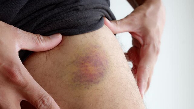 Man pulling up his shorts to show a large colorful bruise on his upper thigh