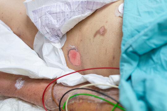Closeup of pressure ulcer wound patient receiving medical care hospital Clinical treatment wound management nursing support recovery healthcare monitoring