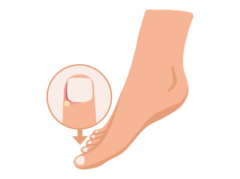 Paronychia Disease in Toenail