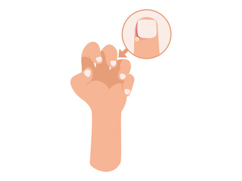 Paronychia Disease in Fingernail