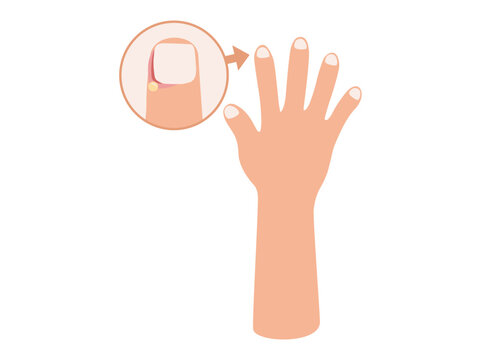 Paronychia Disease in Fingernail