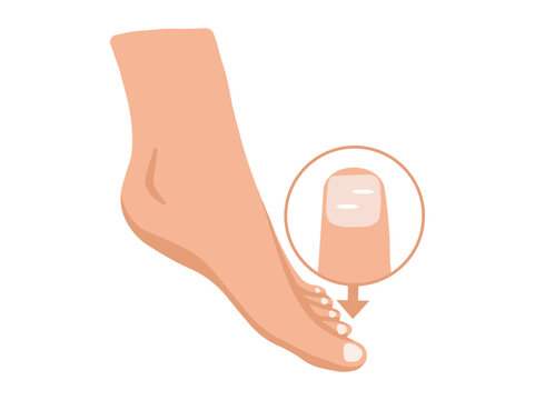 Leukonychia Disease in Toenail