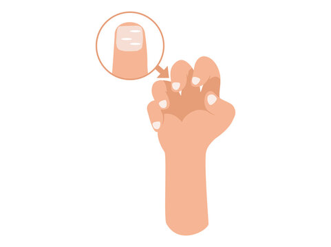 Leukonychia Disease in Fingernail
