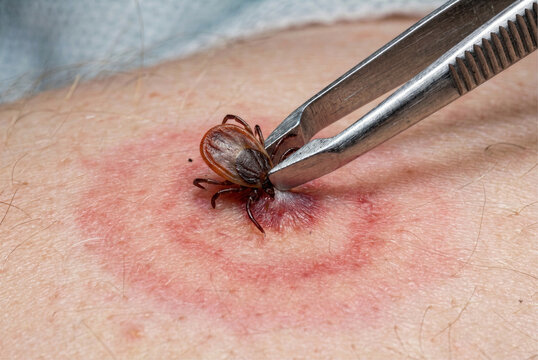 A close-up macro photograph shows an engorged tick being carefully removed from human skin with fine-tipped tweezers. The image highlights the risks of tick bites, skin inflammation, and the importanc