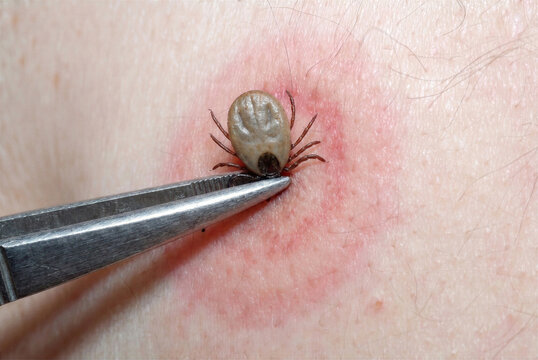 A close-up macro photograph shows an engorged tick being carefully removed from human skin with fine-tipped tweezers. The image highlights the risks of tick bites, skin inflammation, and the importanc