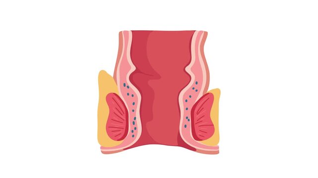 animation of hemorrhoids anatomy and rectal health concept