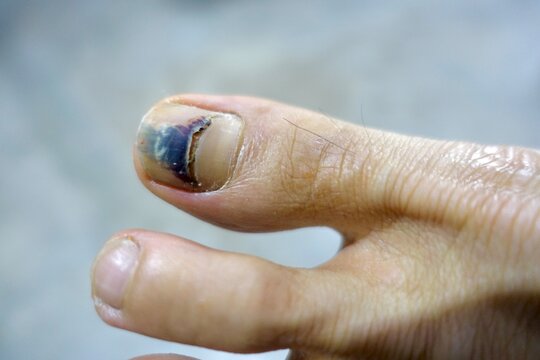 Bruised big toe with healing fracture and minor cyanosis or discoloration during recovery