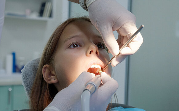Pediatric dentist polishing tooth filling with handpiece for young girl close up