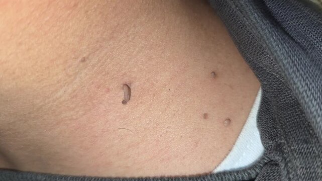 Close-up of multiple skin tags on human neck skin. 4K footage