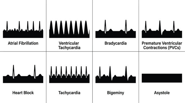 Heart Arrhythmia ECG Waveform Types Chart for Medical Education and Cardiac Health Diagnostics