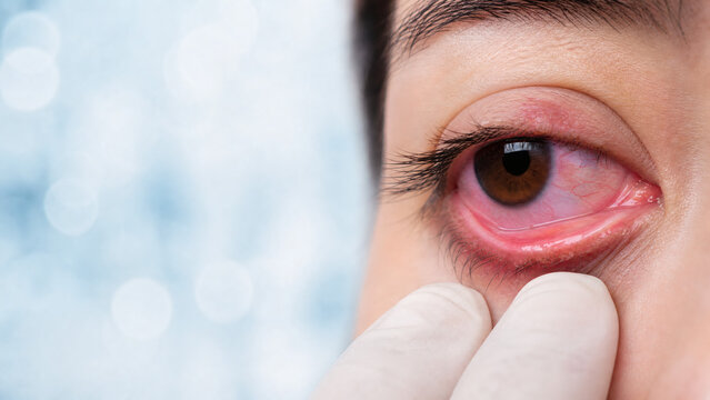 Close-Up Examination of Meibomian Gland Dysfunction with Inflamed Lower Eyelid Margin and Conjunctival Injection