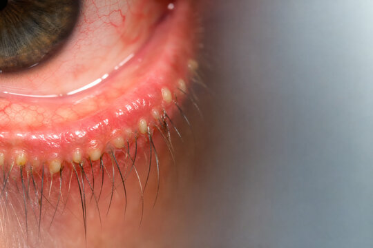 Moderate Meibomian Gland Dysfunction with Inspissated Meibum and Obstructed Gland Orifices