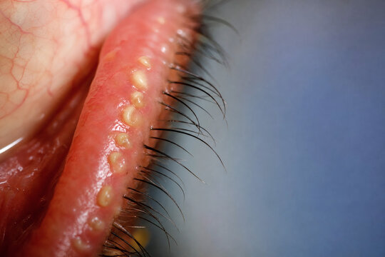 Moderate Meibomian Gland Dysfunction with Inspissated Meibum and Multiple Obstructed Gland Orifices