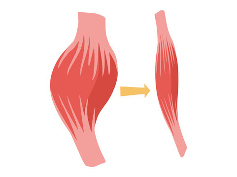 Normal Muscular and Dystrophy Atrophy
