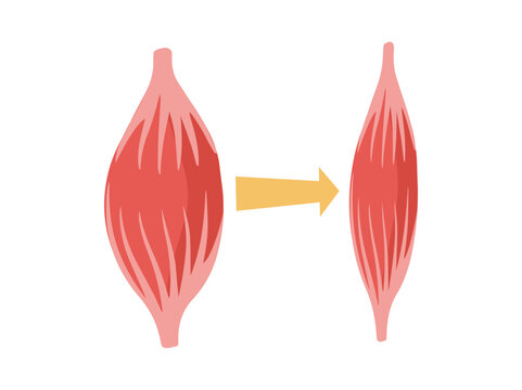 Normal Muscular and Dystrophy Atrophy