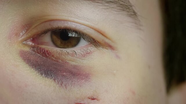 Close up shot of a young man with a bruised eye looking at the camera.