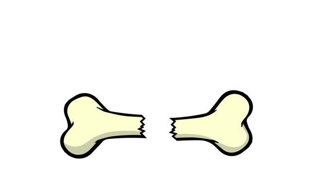 Broken bones. A bone broken into two pieces.