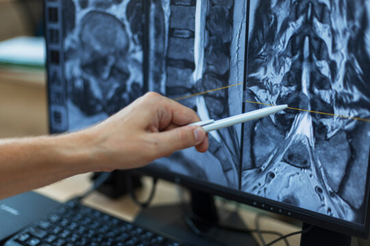Doctor's hand pointing with a pen at a spine MRI scan on a computer screen, analyzing a vertebral hernia, back injury, or spinal cord pathology for medical diagnosis.