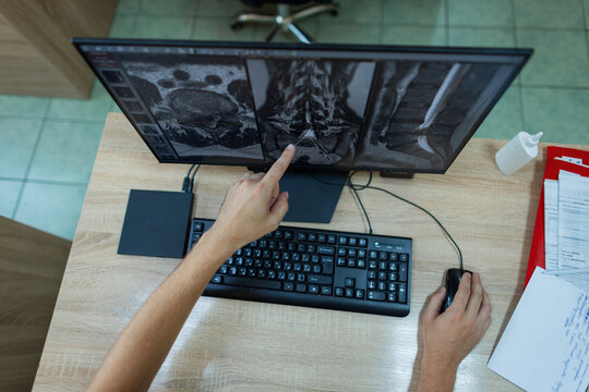 top view of a radiologist examining a lumbar spine MRI scan on a computer monitor, pointing at a vertebral hernia during a diagnostic medical consultation. professional neurosurgeon is working