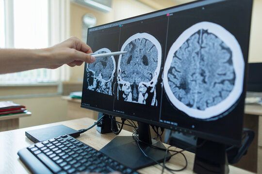 doctor points with a pen at a brain CT or MRI scan on a computer monitor, analyzing head trauma, stroke, neurological pathology for a medical diagnosis in clinic. professional neurosurgeon is working
