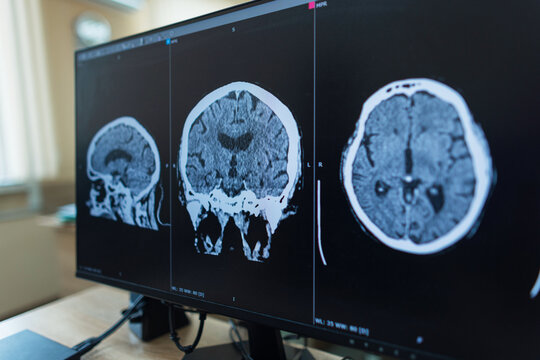 A brain CT or MRI scan displayed on a professional computer monitor screen in a clinic, showing axial, sagittal, and coronal views for medical diagnosis of a head injury or stroke.
