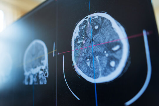 Angled close-up of a computer screen displaying a medical brain CT scan with alignment grid lines for advanced radiological diagnosis, neuroscience research, or neurosurgery planning.
