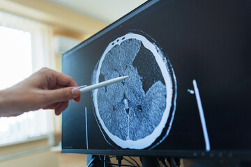 A doctor's hand points with a pen at a computer screen displaying an axial brain CT scan with a...
