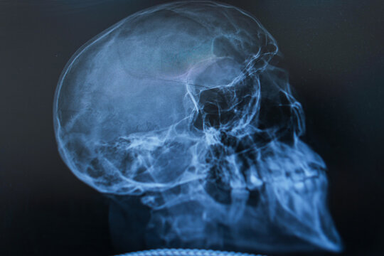 Close-up of a medical lateral X-ray radiograph of a human skull displayed on a monitor, showing detailed bone structure of the cranium, jaw, and teeth for diagnostics.