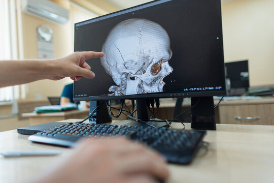 professional neurosurgeon is working at a computer. hand points at a 3D CT scan reconstruction of a human skull on a computer monitor, showing a severe cranial fracture during a diagnostic review