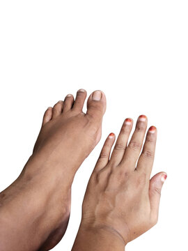 Person showing feet with hammertoes