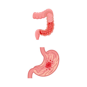 Vector illustration showing anatomy of digestive system with stomach ulcer and colitis