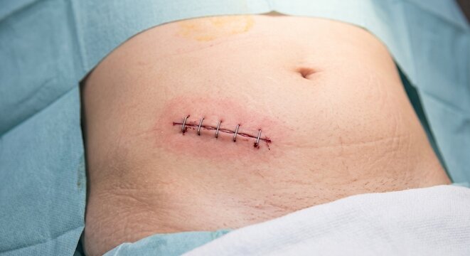 Surgical wound at the end of appendectomy operation for acute appendicitis.